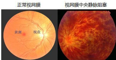 河南眼科圈|为什么眼睛也会“中风”？