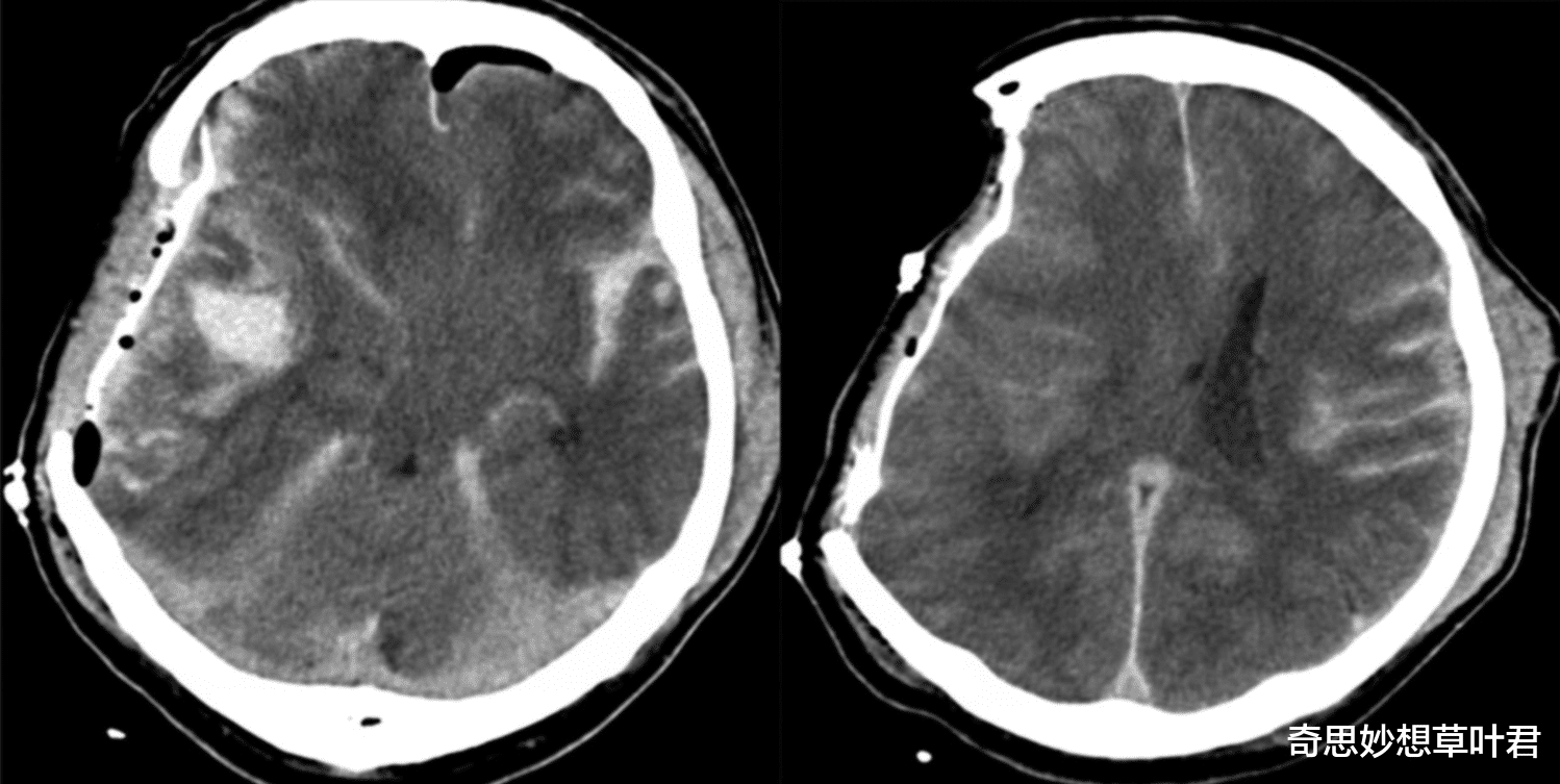 医生 科学尽头是神学？世界首例“无脑人”，娶妻生子还考取公务员！