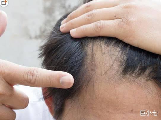 |如果头上出现三个症状,可能是肝脏出现问题,早知道早检查