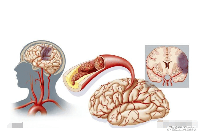 脑梗|血液的“稀释剂”被发现，不是酵素，若你爱喝，血管畅通，脑梗不敢造次