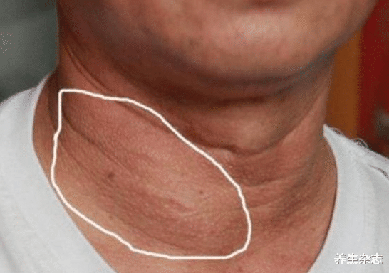 甲状腺癌|48岁男子咳嗽不止，甲状腺癌晚期，医生：身体3异常，预示癌细胞转移