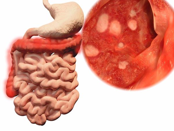 排便|肠息肉是否会癌变？医生劝告：这3种变化，或是息肉癌变后的表现