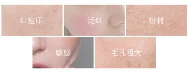 黑头|我国有一款“不起眼”洁面皂，能控油除螨去黑头，却因价低被忽视