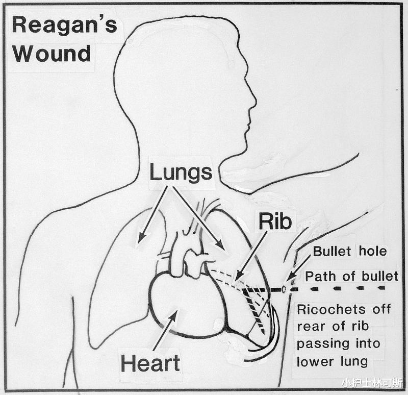 牛奶|肺小结节是什么?身体出现肺小结节该如何治疗?
