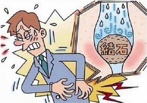 柚子欧尼 如何对付疼痛难忍的“肾结石”！