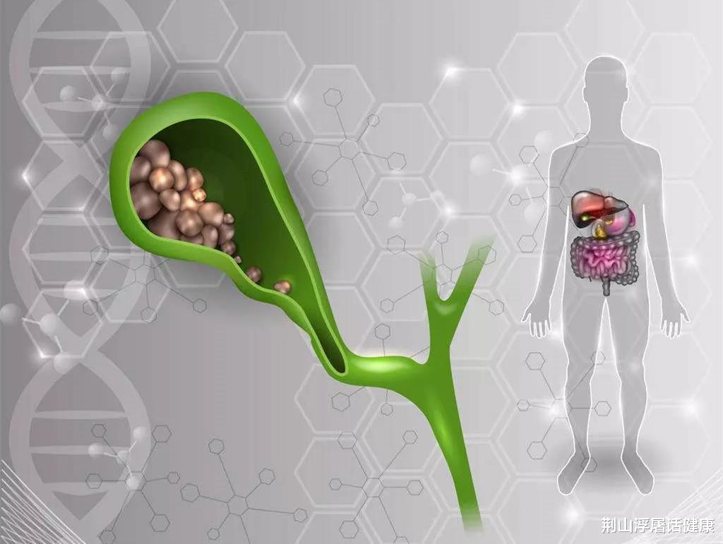 荆山浮屠话健康|体检做腹部彩超发现胆结石，但没有症状，该怎么办？要拿掉吗？