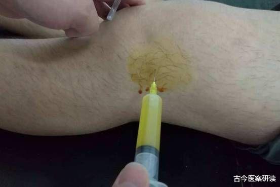 滑膜炎|滑膜炎逃不出这3点，若不想膝盖“报废”，这1零食可敞开吃，补骨更养骨