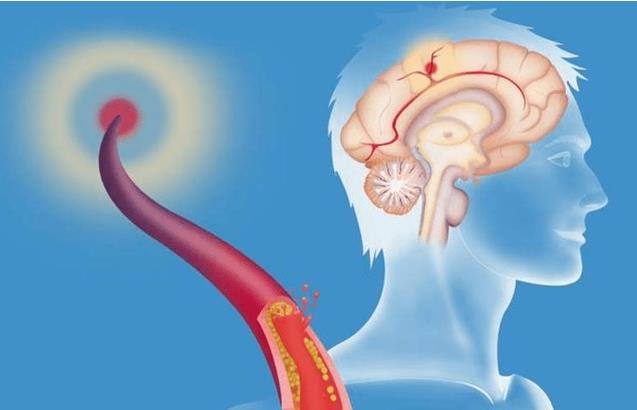乙肝|53岁男子因挑食躲过脑梗,医生夸赞:少碰3物,或对血脂好