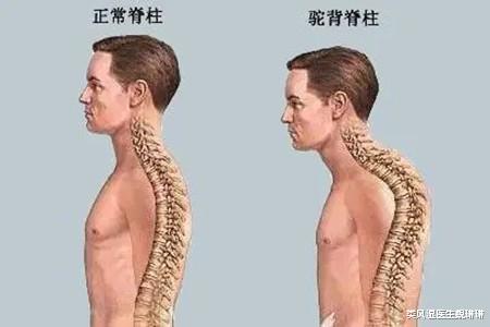 类风湿医生魏琳琳 强直性脊柱炎会遗传吗？你需要这样的正确预防！