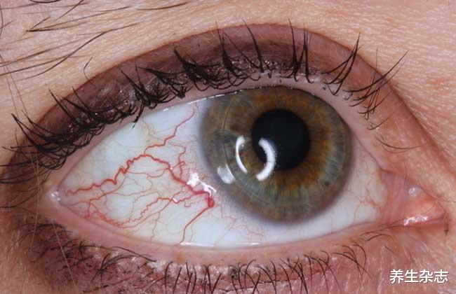 脑梗|脑梗多半是吃出来的，大夫提醒：脸上出现“2”处异常，尽快检查脑CT