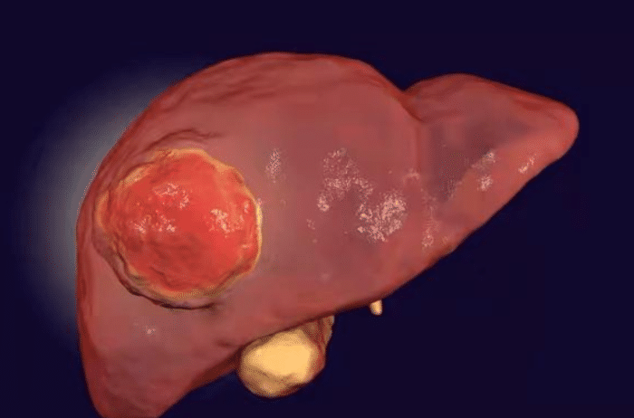 肝脏|肝硬化的“根源”被揪出,医生提醒:不想肝“报废”,这4物白给也不要