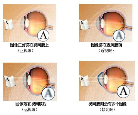 视界沐光VR视力|暑假期间应该怎样保护孩子的视力?