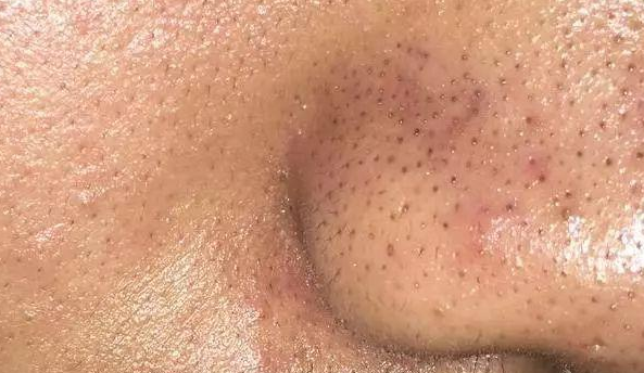 黑头|黑头粉刺不断惹人烦，去除它们要用对方法！