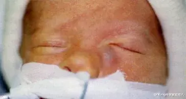 DrKing科学家庭育儿|这种先天性眼病，极易拖成泪囊炎！娃眼屎多是第一征兆！