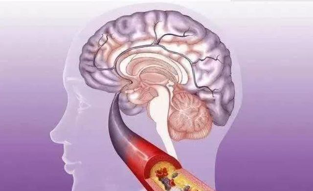 失眠|脑梗的“源头”或已发现,肥肉未上榜,第一很多老人经常吃