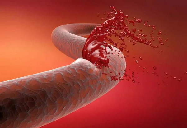 脑梗|脑梗“祸根”不止烟酒，这4物尽量少吃，多吃一口血管可能多堵1分