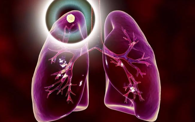 番茄|吃一口胜过10斤番茄，肺科医生：若能爱吃，养肺散结，肺恢复健康