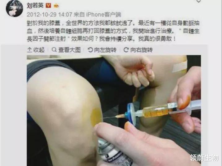 领蔚生物|刘若英治疗膝盖用的是干细胞吗？