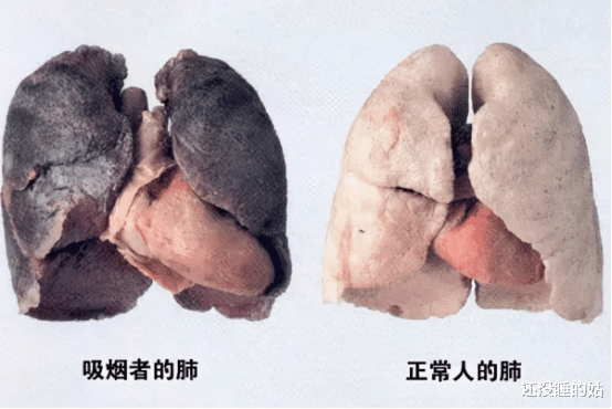 肾结石|戒烟后，变黑的肺还能再变粉吗？肺功能多久可恢复？男士都该看看
