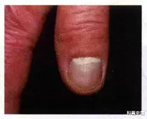 真菌感染|涨知识！原来指甲有斑点、竖纹、变厚竟预示着这些病…