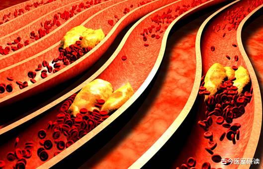 海带|血管“疏通剂”已找到，不是海带，你若爱吃，血脂稳稳降，脑梗绕着走