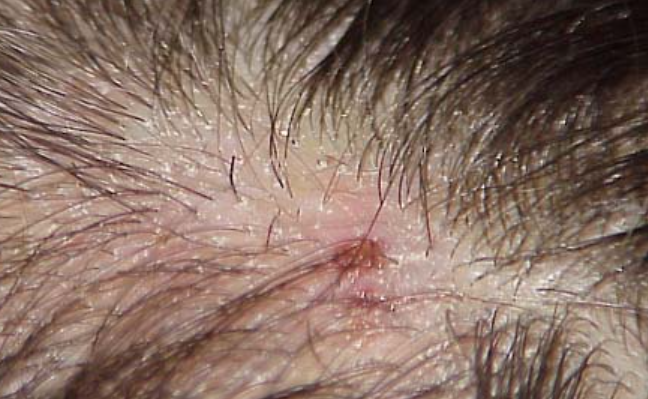 毛囊炎|无意中发现头皮“小疙瘩”,该不该抠下来?医生给您靠谱的答案