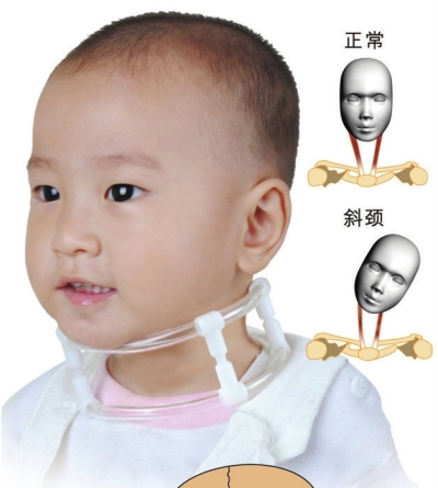 青城小医仙|小男婴头老歪向一边是怎么回事，医生：绝对不能大意