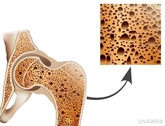 肾虚|男子双腿乏力，误认为是肾虚，3个月后不幸瘫痪，医生：“2菜”怎能天天吃