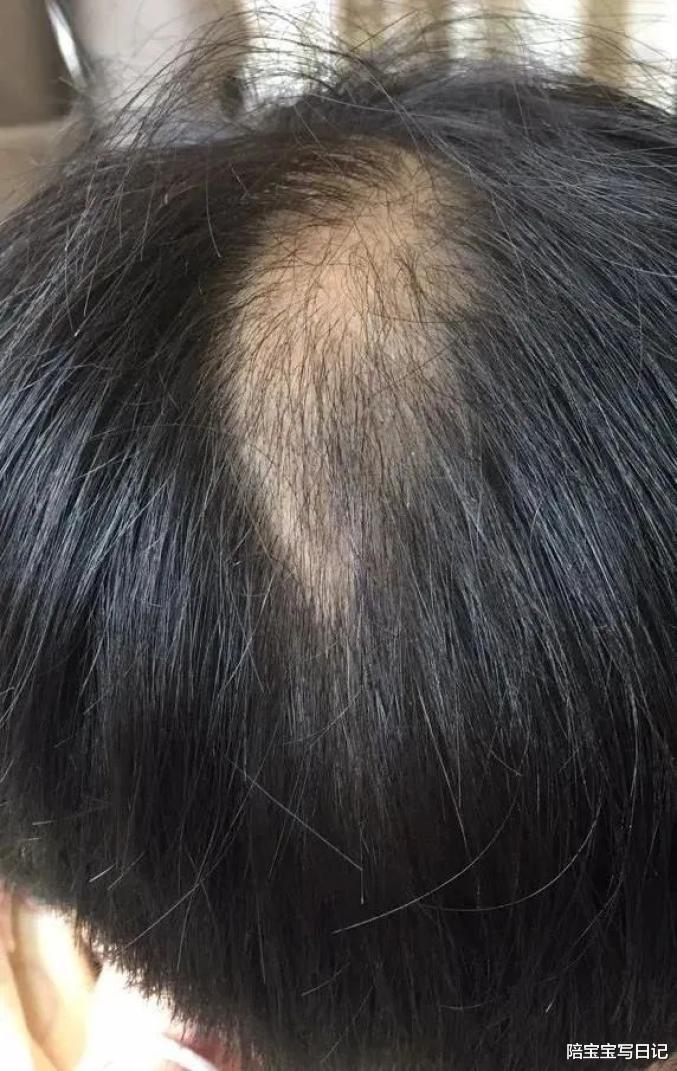 陪宝宝写日记|被逼着学习,孩子焦虑得了斑秃:有些家长正在悄悄被惩罚