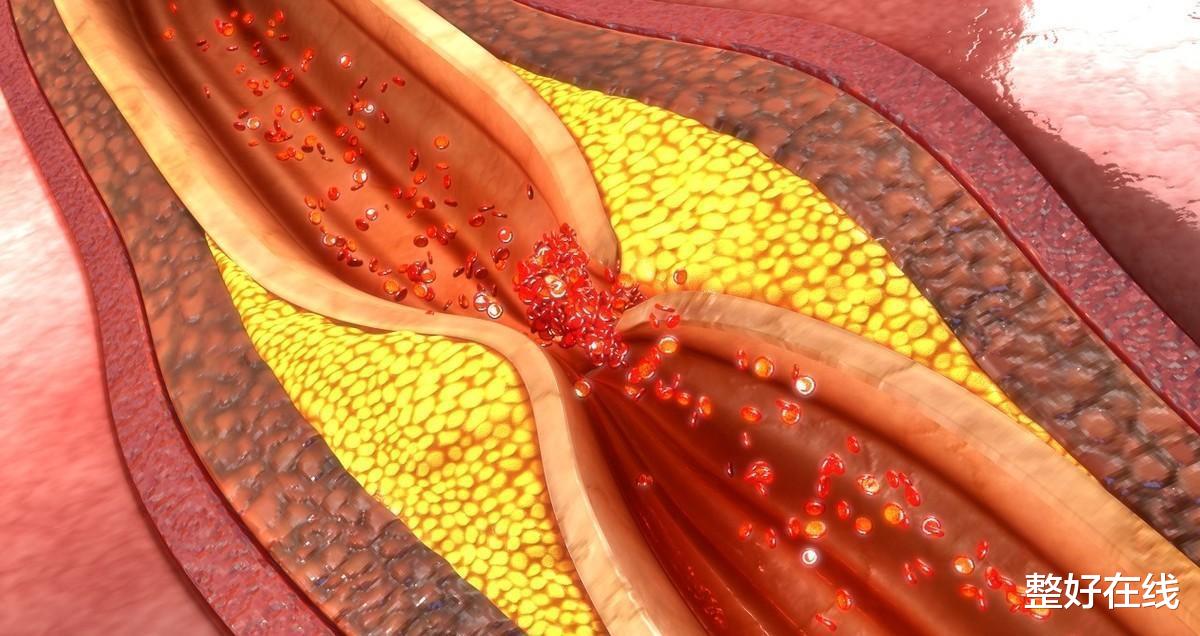 整好在线 医生提醒：身体出现7种“不舒服”，可能是血管堵塞！不妨自查