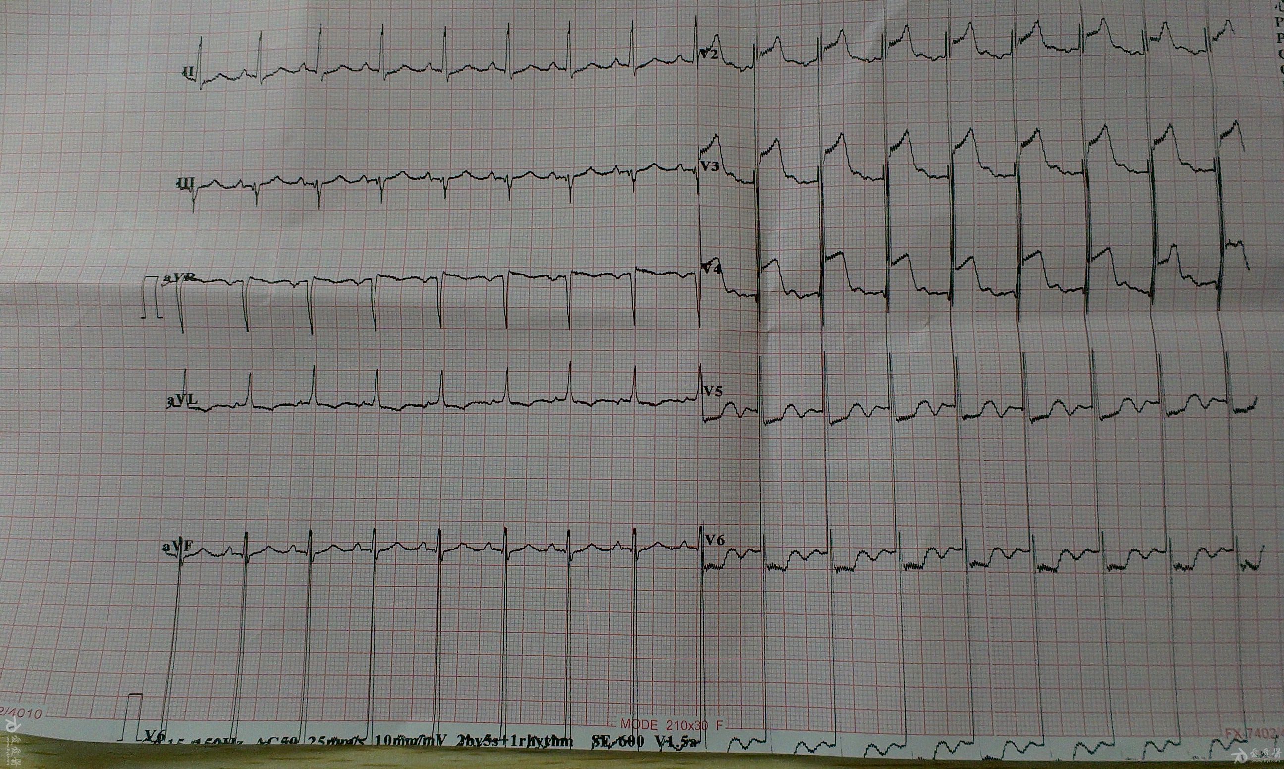 心电图刘医生|心肌梗死发生前有没有预兆,很多人说没有,其实是你没在意!