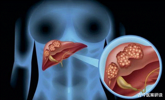 肾病|吃一口等于十斤决明子,肝科医生:肝不好要多吃,养出“金刚”肝