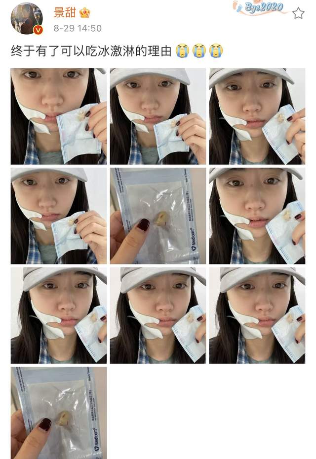 景甜|景甜素颜曝光认不出，怼脸自拍双眼皮疤痕明显，曾大方承认整容