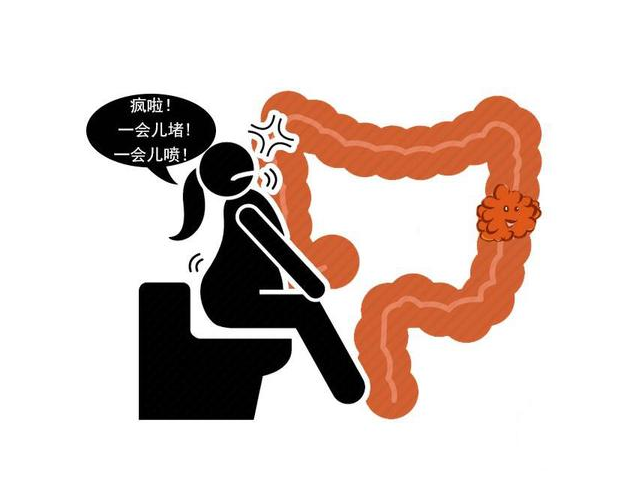 肠癌|肠癌并非静悄悄！医生叹息：患上肠癌的人，往往忽视3种排便信号