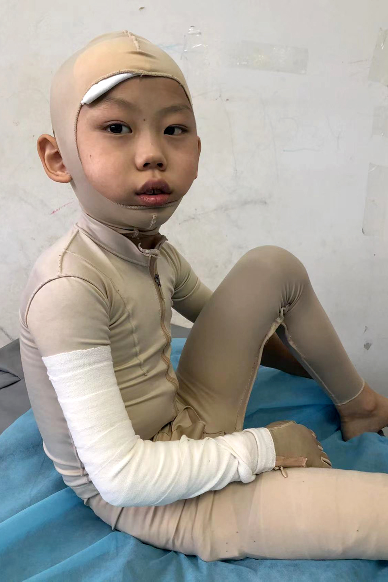 用了11年的太阳能热水器突然爆裂,6岁男孩被严重烫伤,妈妈崩溃