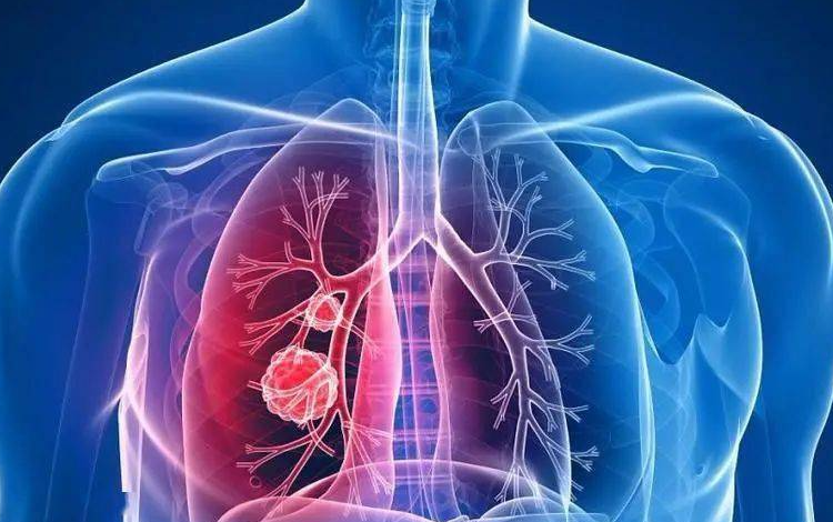 呼吸科姚宏胤医生|肺部小结节会变为癌症吗?