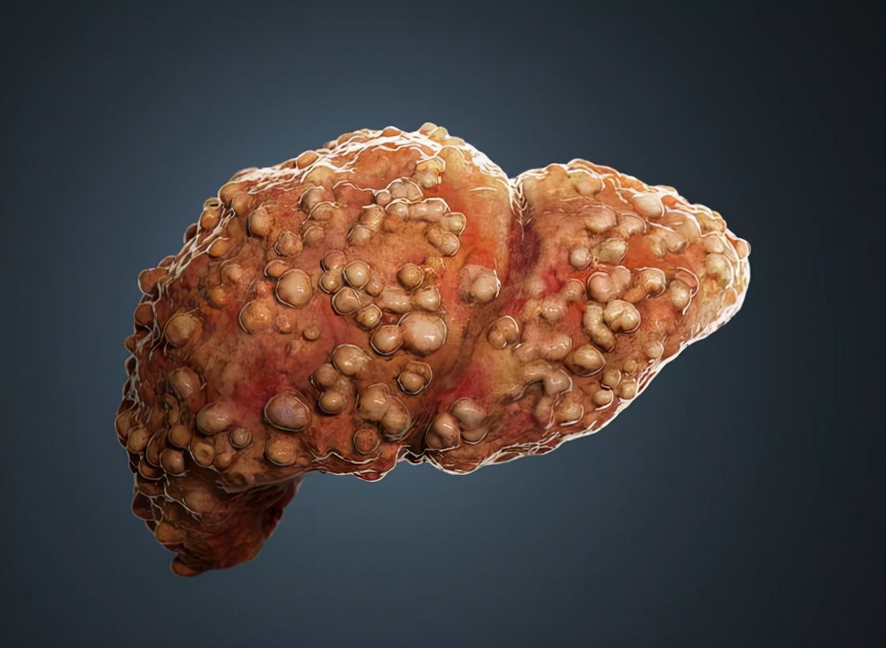 肿瘤|每天吃萝卜，50岁大哥肝癌离世，医生：萝卜这样吃，是“自毁”肝脏