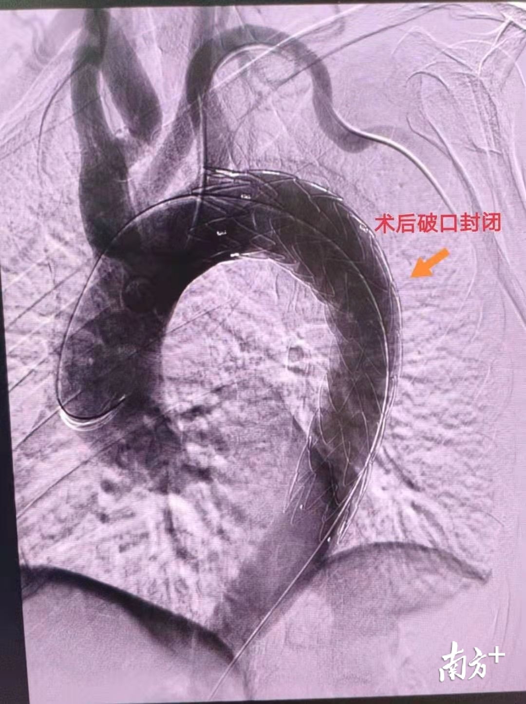 天天读报会 过年跟家人吵了一架，七旬阿伯突发主动脉夹层破裂引发“生死大救援”