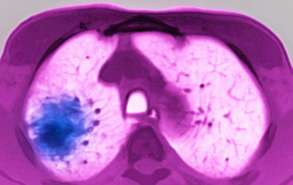 用户_胡洋|肺癌治疗过程中，通过哪些指标可以判断病情在逐渐好转？