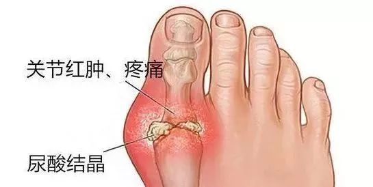 痛风|痛风患者常常出现这些并发症，这两种蔬菜需要适量使用。