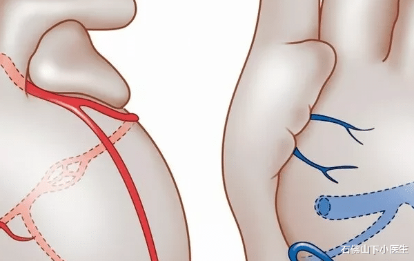 石佛山下小医生|冠状动脉狭窄多少，会出现明显的心绞痛