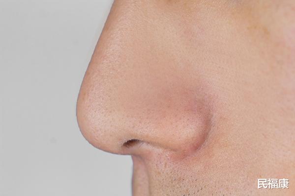 痘痘|为什么不建议经常挖鼻孔?会让鼻孔越来越大吗?