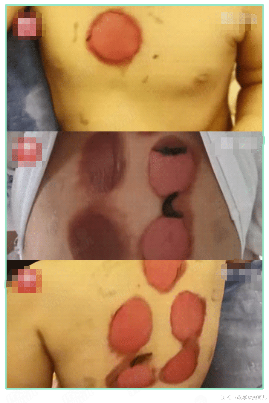 DrKing科学家庭育儿|92名儿童被灼伤,“啥病都能治”的三伏贴,背后5大风险惊人!