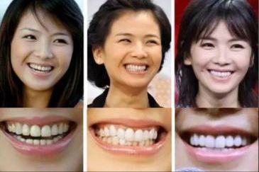 刘涛|这些明星做了烤瓷牙后，颜值反而下降了，连刘涛自己都后悔了！