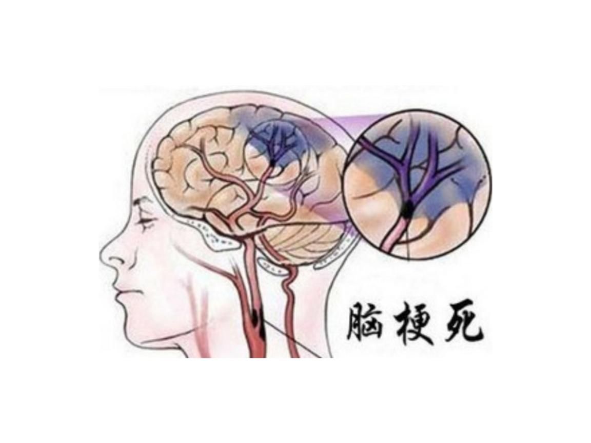 中科西部细胞研究院|中科西部干细胞研究院：什么是“脑梗死”？干细胞治疗能行吗？