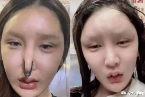 臀部|臀部割皮给眼睛做卧蚕，没想到翻车来得太快，男友：你眼睛丑死了