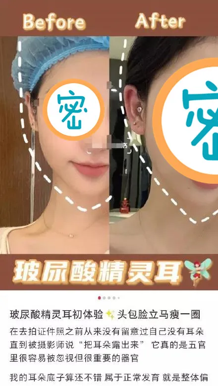 |网红圈又刮起了一阵“精灵耳”审美,网友:这不是祸祸年轻人吗?