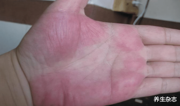 红糖|38岁男子转氨酶高达560，确诊肝衰竭，医生：家有这“1杯”，趁早扔掉