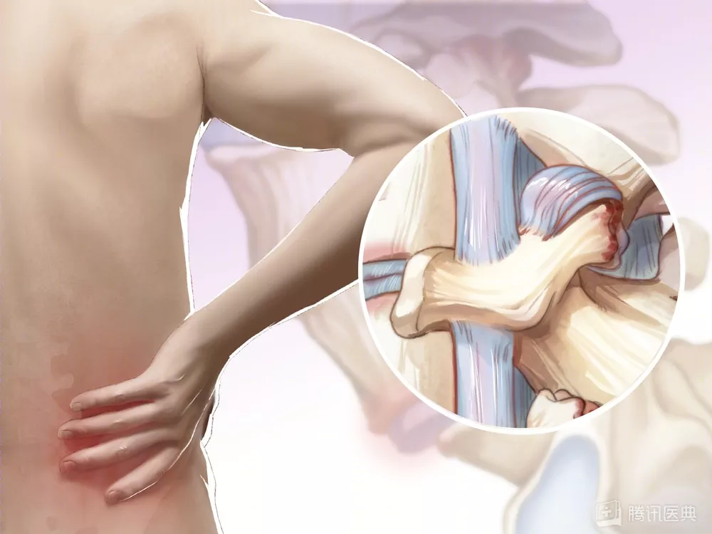 按摩|奖门人:不小心闪了腰,千万别随便按摩!教你这5招,止痛很管用