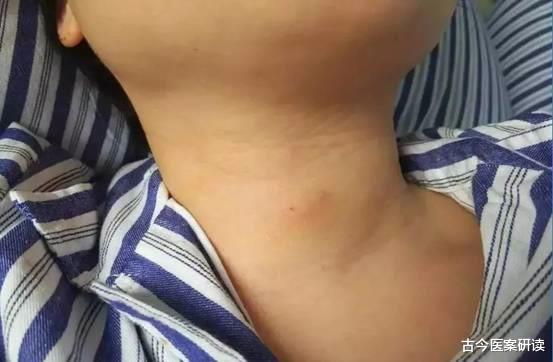 古今医案研读|结节的“加速器”不止大蒜,甲状腺医生呼吁:2菜2果,也要少吃